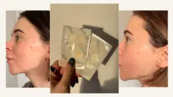 Hero Mighty Patch Review for Acne Spots